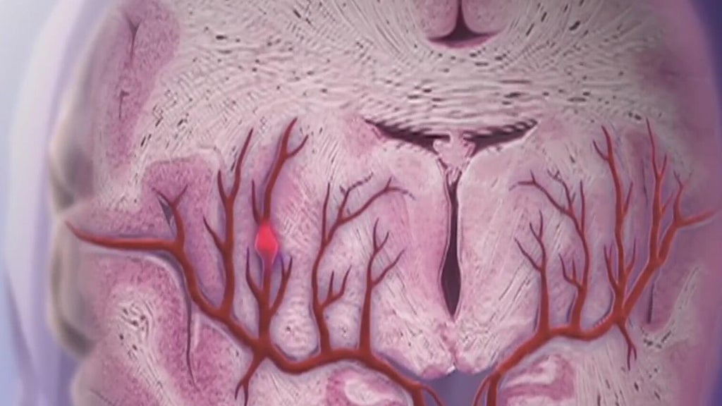 Knowing the signs of a stroke can save lives — East Cobb Community news